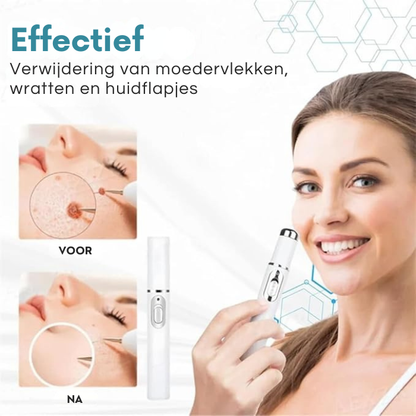 Huidverzorgingsapparaat – Verwijder Moedervlekken, Wratten en Huidflapjes