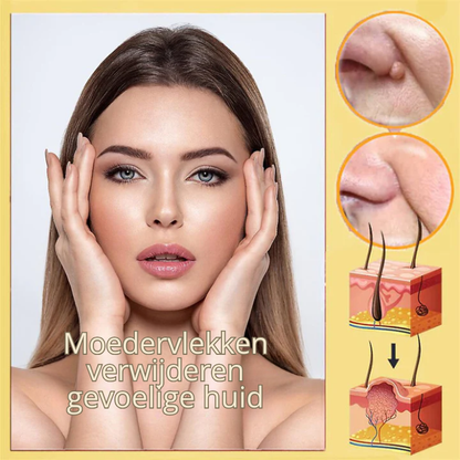 Bijenwesp Extract Verwijderaar – Voor Moedervlekken en Wratten – Ontstekingsremmend