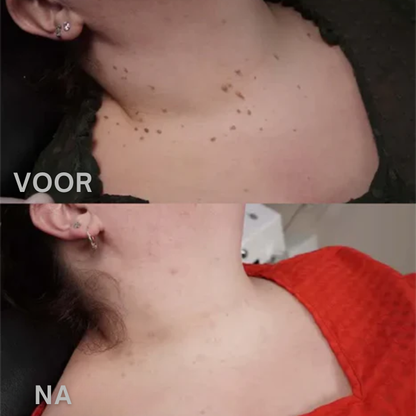 Bijenwesp Extract Verwijderaar – Voor Moedervlekken en Wratten – Ontstekingsremmend